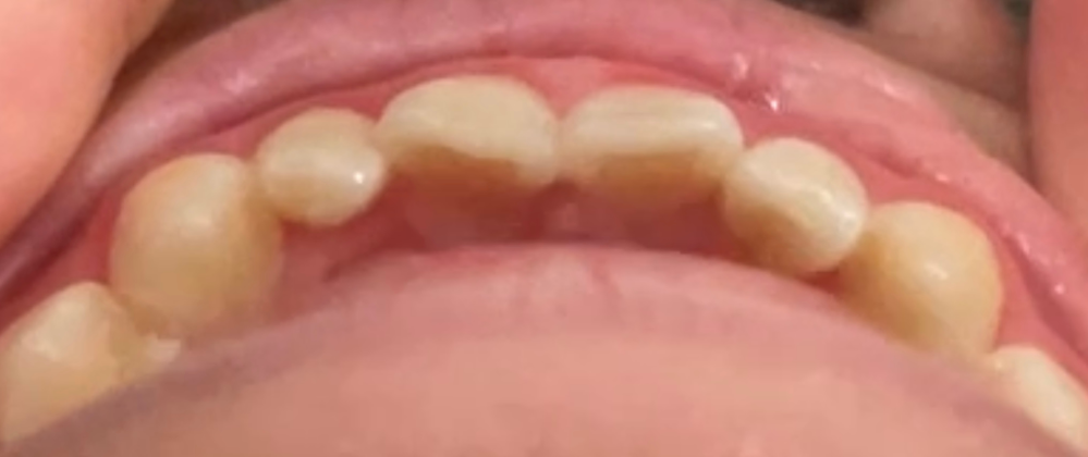 この歯は、部分矯正適応ですか？
