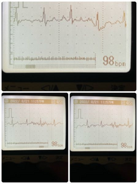 携帯心電図で初めて波形に乱れがありますとでました これは心臓のどんな病気 Yahoo 知恵袋