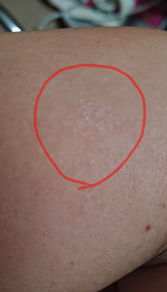 皮膚の病気 アトピー 解決済みの質問 Yahoo 知恵袋