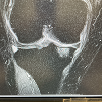 骨挫傷について50代女性2週間前から立ち上がり時 歩き初めに右 Yahoo 知恵袋
