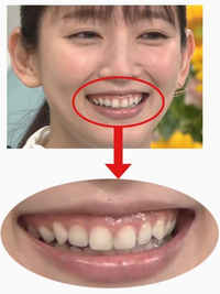 吉岡里帆さんはガミースマイルに該当しますか Yahoo 知恵袋