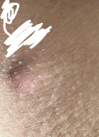 何日か前からお股の横のちょうどvラインの所にこの用な出来物 が Yahoo 知恵袋