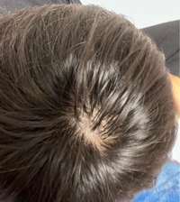 これってツムジ禿げですか 光に当たるとこんなにも頭皮が透けて見 教えて しごとの先生 Yahoo しごとカタログ