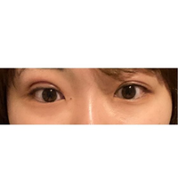 埋没について質問です。

11月の頭に55万円という大金を支払って腫れない強度が強い埋没整形をTCBで受けました。 写真で見て右の目は埋没翌日から腫れが引いたのですが、左の目が2週間経っても写真のように腫れているのですが、腫れは引くのでしょうか？

また、昨日まで綺麗だった右の目も朝起きたらカクカクした二重幅になっていました。これは整形失敗ですか？
すごくショックでどうしたらいいのかわかりま...