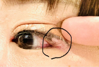 先日眼科にてコンタクト作成時、
医師から逆さまつげがあるよと言われ、
よくよくみてみたら上下目頭に真逆の生え方をしているのが数本ずつあり、目ヤニが出ます。 (ただしかなり短いのでビューラー等の対処のしようがなし)

あと、1番の悩みが目尻のキワに入り込む
まつげなのですが、
痛くて触ってしまい、ひりひりします。
アイラインを引いても数時間で涙に負けてしまい、、、
こちらも、ビューラーでは挟め...