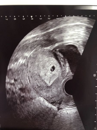 5週目でこの胎嚢の大きさは小さいですか 顕微受精をして胚盤胞移 Yahoo 知恵袋