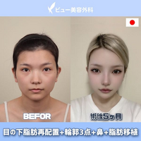 この方って目が離れ目気味で、すでに涙丘が見えているのでこれ以上目頭切開な... - Yahoo!知恵袋
