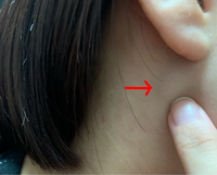 だいぶと前に発見してから違和感なく日常生活送ってますが…右耳、耳たぶの真... - Yahoo!知恵袋