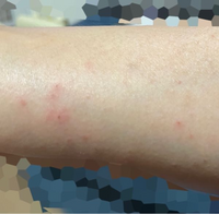 これってダニ刺されっぽいですか？このような感じのものが体にたくさんあります。 