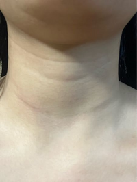 高校生女です。写真のように首にシワがあります。最近ものすごく気になるよう... - Yahoo!知恵袋