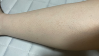 医療脱毛の照射漏れについてです。

1ヶ月前に医療脱毛をしました。

ところどころ塊やライン状で残っており、本日見てもらったところ照射漏れは認められないという事でした。 「塊で残っているように見えるだけで抜けている毛もある。」「照射漏れならもっと生えてる」「毛周期の問題」と言われたのですが、なぜ抜けている毛があると分かるのでしょうか。また、抜けてる毛があったとしても医院が主張していた...