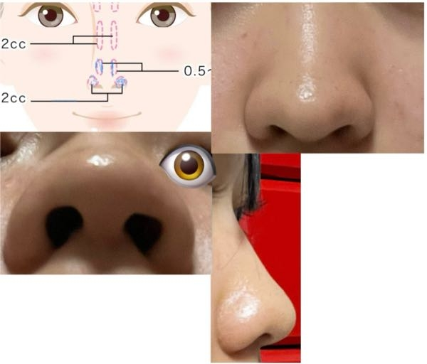 TBCの小鼻縮小脂肪溶解注射BNLS アルティメットは効果がありますか？ 写真のような肉厚だんご鼻