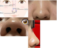 TBCの小鼻縮小脂肪溶解注射BNLS アルティメットは効果がありますか？
写真のような肉厚だんご鼻で、鼻翼と小鼻周辺(青い印がついている部分)に注射したいと思っています。 