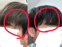 中学生です。横向いた時に髪が薄くなっているのが見えるんですけどこれは普通なのですか？ 