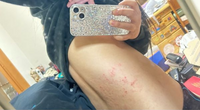 原付乗ってたんですけど巻き込み事故で怪我しちゃってめちゃくちゃ痛くて少し動くだけで腰からお尻にかけてビリビリして、でもこの跡が、ただのニキビのブツブツか事故によってできた怪我か分かりません。 片側しかブツブツと腫れてないので事故の怪我かと思ったのですが、ただ衝撃で赤くなってニキビが浮き出てきた？という可能性もあると思いまして。。
詳しい方教えてください！