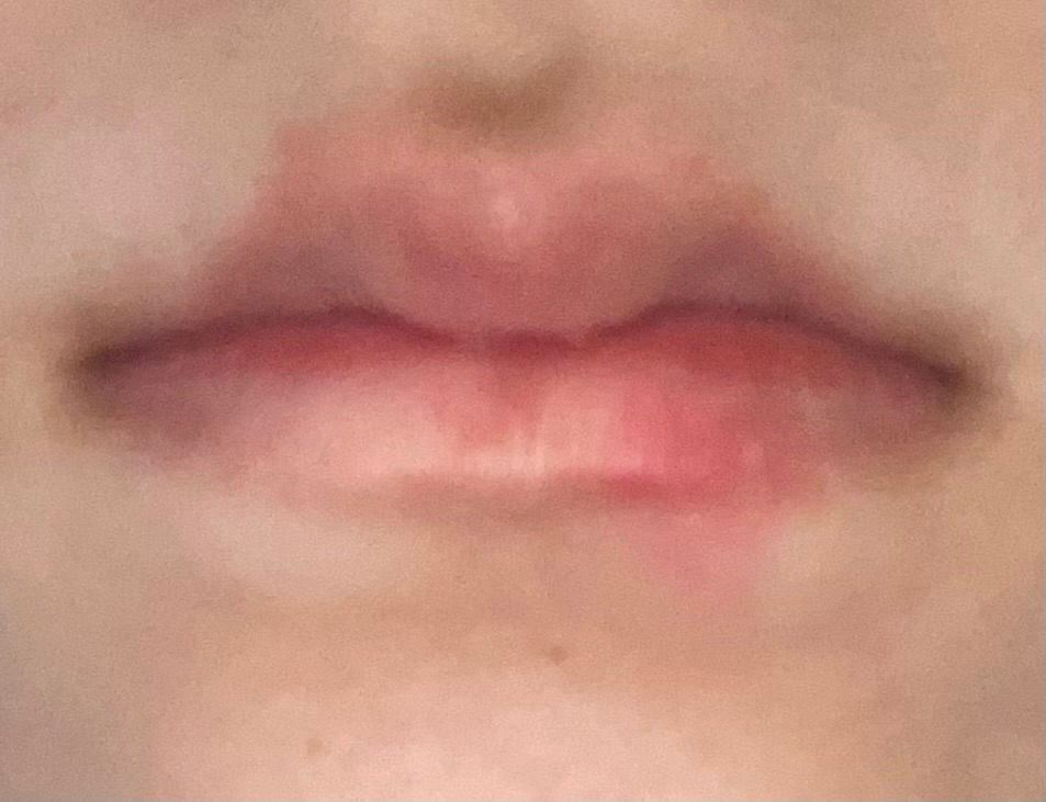 至急！トランペットしてます。唇にできもの？ができてしまい、腫れています。唇の赤い部分とその下の肌の部分の境目？にできものがある感覚です。明日本番があり、どうしたら良いでしょうか。対処法はありますか？？