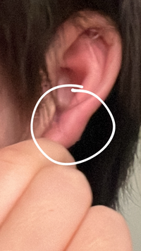 朝起きたら20mmの透ピが埋まる勢いで耳たぶが腫れてるんすけど、押しまくったらちょっとずつ膿？が出てきます。だけどその分固くなっていきます対処法ありますか？ 
