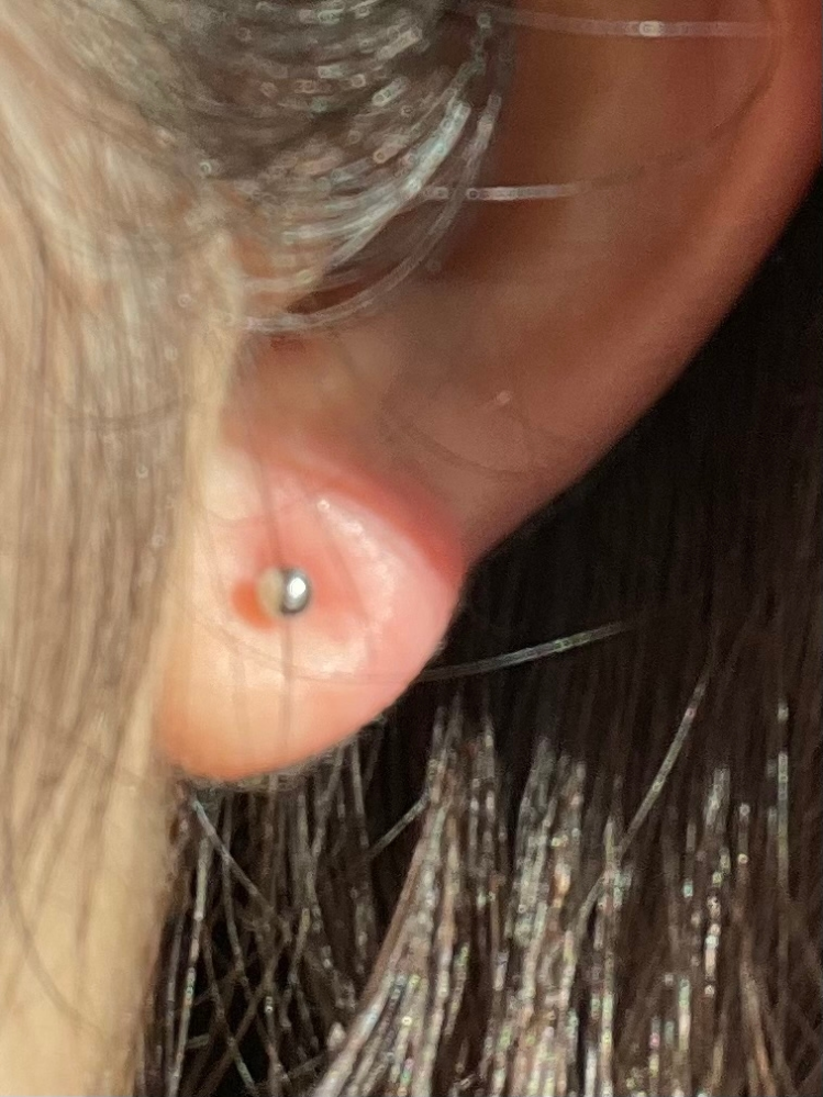 先程ピアッサーでピアスを開けたのですか、左耳だけ上の方が盛り上がってる気がします。これはこのままでも大丈夫なのでしょうか？ 教えて頂けたら幸いです> <