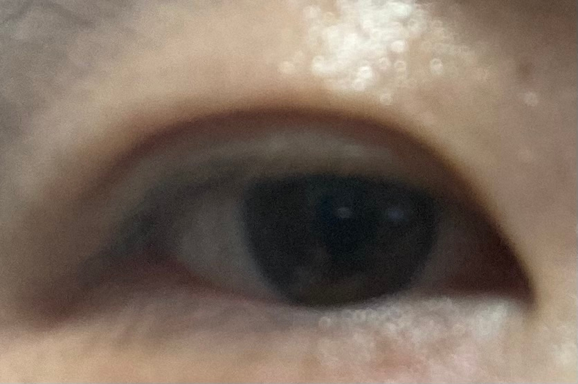 2週間前に二重の埋没法をしました。 ここ1週間、あまり目の変化が無いのですが まだ腫れているように見えますか。 奥二重に近しいラインを希望していますが、 結構幅広になってしまいました。 眠そうな目に見えると思いますが、 写真はちゃんと前を見た状態です。 ※目を見開いても、黒目は一部隠れます。 不安な気持ちがあり病院に連絡するべきか もう少し様子を見た方が良いか、 アドバイス頂けますと幸いです。