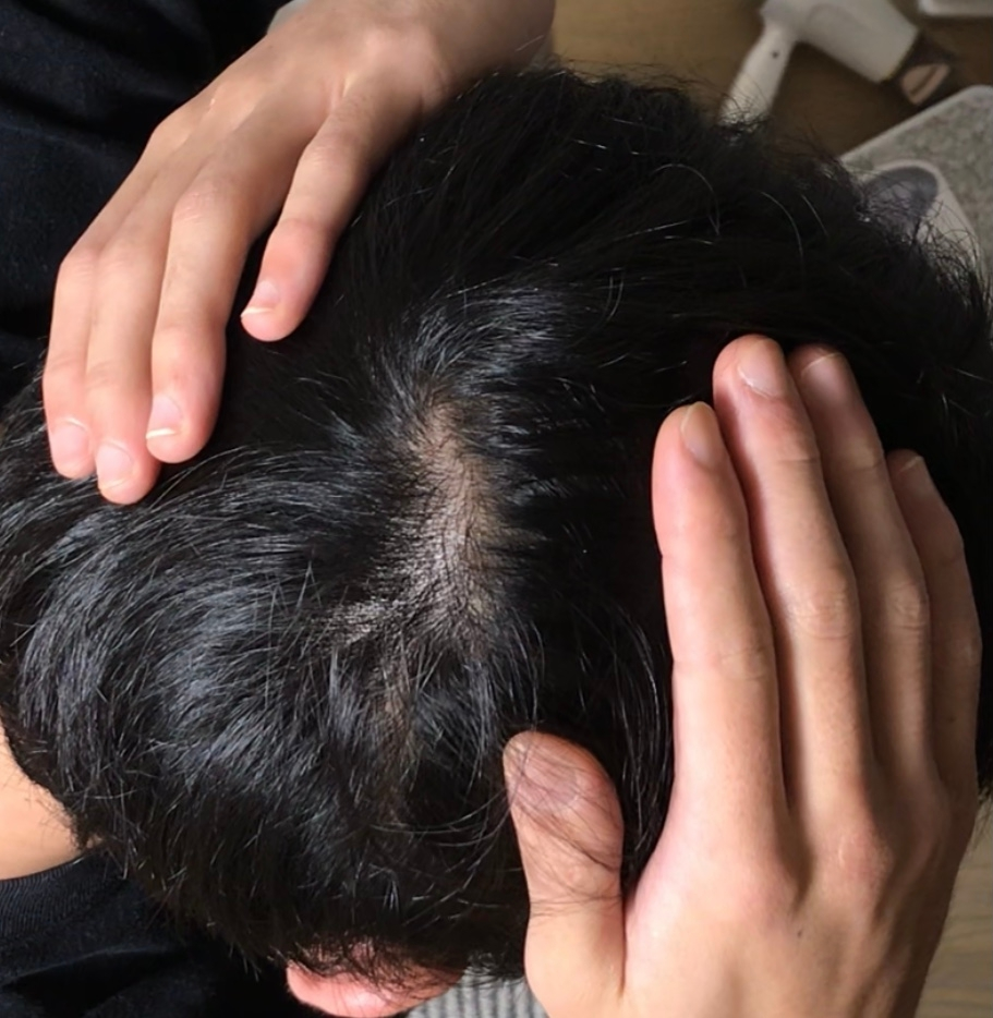 19でこのハゲ具合は深刻なのでしょうか。ちなみに触れた感じは見た目よりかなりスカスカです。AGAのお医者さんに罹るべきか悩んでいます。出来れば同世代の方々、率直な感想をお聞かせ下さい。