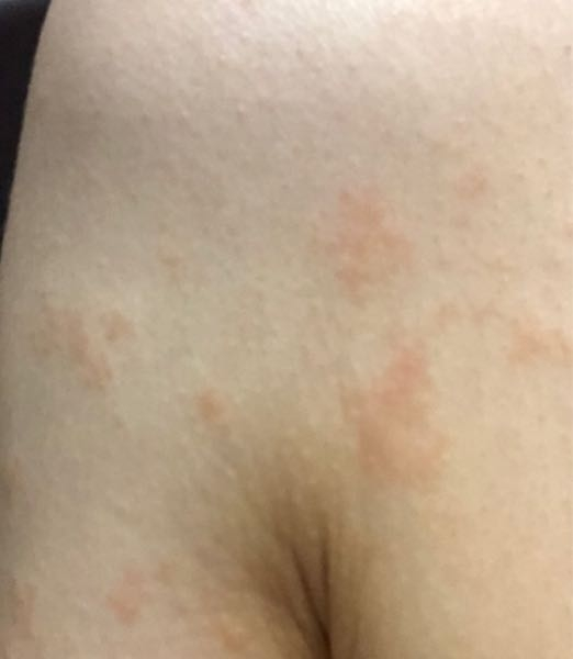 Cancer Rash Between Breasts