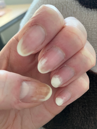 爪の剥離について質問です。

半年ほどセルフでジェルネイルをしていたのですが、薬指、小指の爪が剥離してきてしまいました。

親指の爪は薄くなったのか色がおかしくなっています。 画像は左手ですが、右手も同様です。

今は生活を保ち保湿を心がけていますが、皮膚科に行った方が良いでしょうか？

ご意見をお願いします。