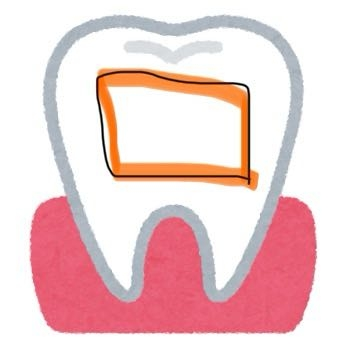 歯科で保険適用になるかわかる方お教え下さい。 現在30代なのですが、 10代の頃歯科矯正(歯の表面に付けるタイプ)をしており、矯正後前歯のでこぼこを消すため詰め物を歯の表面にしました。 現在、...