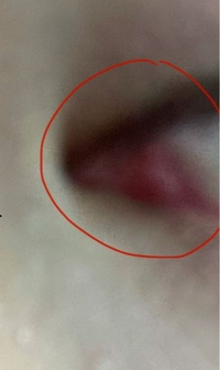 涙丘？目頭のピンクの部分が前よりも少し腫れて白目の方に大きくなっている気... - Yahoo!知恵袋