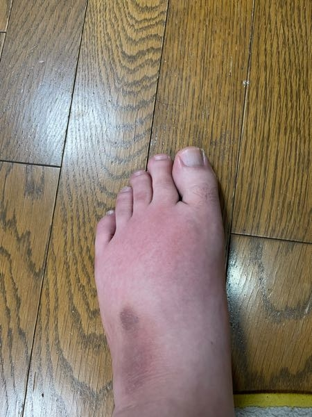足の甲からつま先にかけて、かなり激痛がするのですが、見た感じ何かなってえりますか？ 宜しくお願いします。