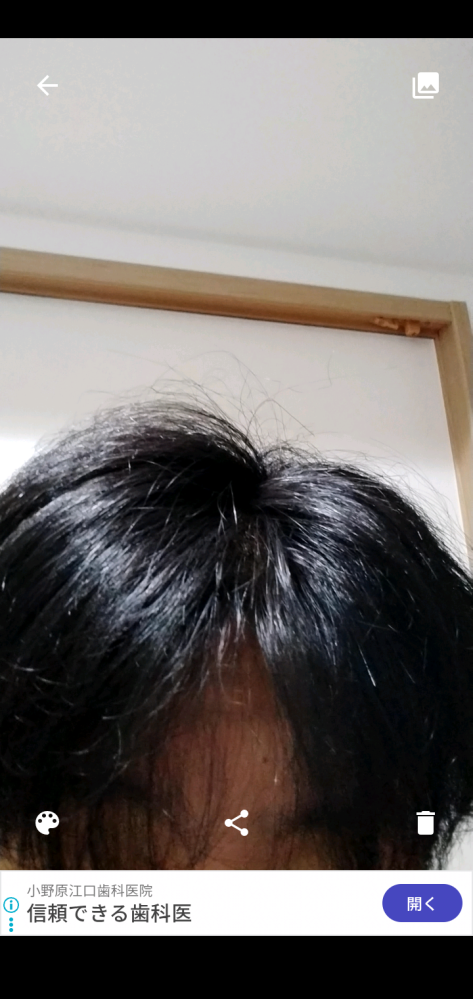 この髪質って将来禿げると思いますか？もし禿げなさそうならこれか