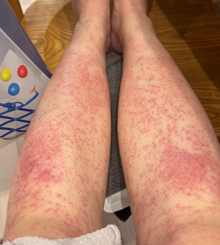 皮膚 ヒリヒリ 外傷なし 知恵袋