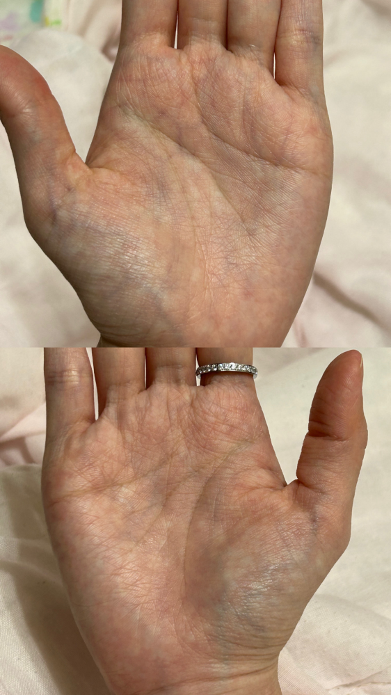 手相について質問です。左手の生命線に島があるのですがこれは大病に
