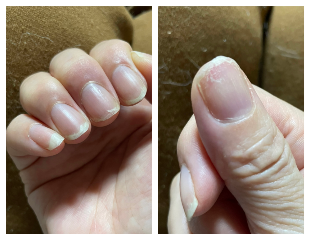 JNEC認定モデルハンドについて質問です。みなさん骨折と言って