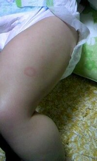 7か月の赤ちゃんの輪っか状の発疹について 7か月になる娘 Yahoo 知恵袋