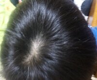 若ハゲ治し方 僕は15歳ですけど頭頂部がかなりうすいと思います どう Yahoo 知恵袋