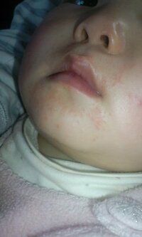 一歳三カ月の娘の口周りの湿疹が治りません アドバイスよろしくおねがいしま Yahoo 知恵袋