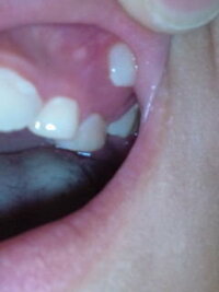 歯 見える から 歯茎 が 歯茎の目立つ子供