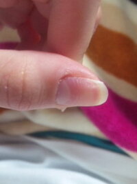 爪の表面がぼこぼこしてます両手の親指のみが横の線でボコボコしてます原因は Yahoo 知恵袋
