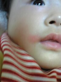 五ヶ月の赤ちゃんがいます 今朝口の横に赤い湿疹ができていました 最近離乳 Yahoo 知恵袋