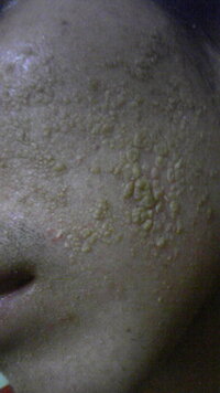 角質のことで悩んでます １年前ニキビがあって皮膚科に行き塗り薬 Yahoo 知恵袋