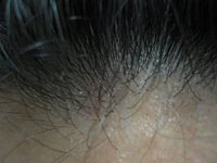 自分の頭皮は脂症で生え際の抜け毛も多いです また洗髪後の頭皮は Yahoo 知恵袋