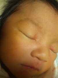 新生児の両目頭瞼にある赤あざについて 出産当初 先生からちょっ Yahoo 知恵袋