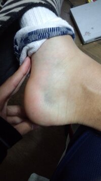 右足の踵に近いあたりにアザが出来ているのですが 打ち身な Yahoo 知恵袋