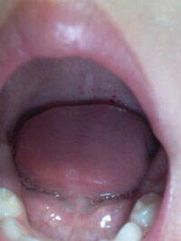 子供の喉の赤い斑点 先ほどから 二歳の息子が喉が痛いというので 見てみた Yahoo 知恵袋