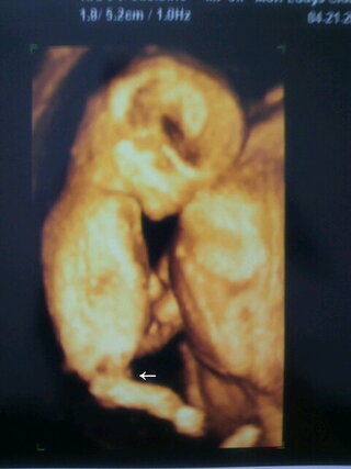 １２ｗ終わりの４ｄエコーです 男の子のシンボルの可能性ありますか まだ早 Yahoo 知恵袋