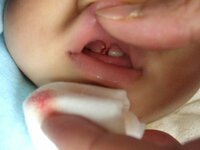 上唇小帯についてです 現在8ヶ月の赤ちゃんがいます 上の歯3本 下の歯3 Yahoo 知恵袋