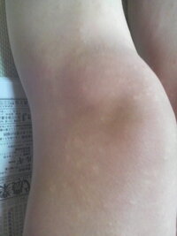 日曜日より米つぶ位の蕁麻疹ができました かゆみもひどいです 皮 Yahoo 知恵袋