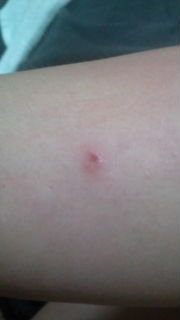 猫アレルギーでしょうか？こんばんわ先月子猫を拾って飼い始めたん 