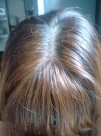 頭皮について質問です １７日にポニーテールをして海に行きました Yahoo 知恵袋