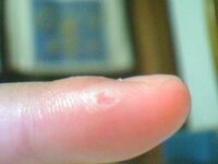 花火で火傷をして 今この状態でヒリヒリしてる感じです 現在は火傷をしてか Yahoo 知恵袋